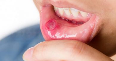 Nhiệt miệng là những vết loét tại các mô mềm bên trong miệng