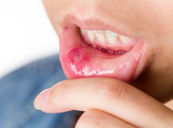 Nhiệt miệng là những vết loét tại các mô mềm bên trong miệng