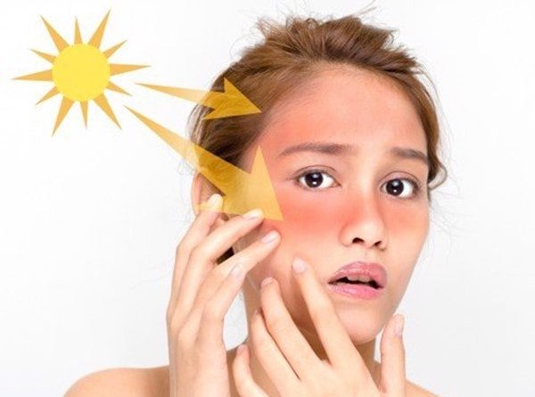 Cách chữa cháy nắng bằng sữa tươi