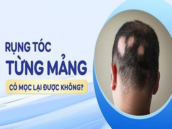 Rụng tóc từng mảng có mọc lại được không?