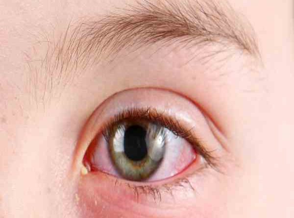 mẹo chữa đau mắt đỏ nhanh nhất