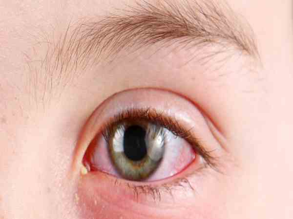 Đau mắt đỏ là gì?