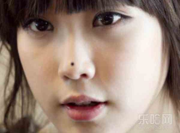 Nốt ruồi trên sống mũi