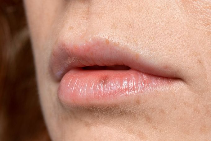 Kích thước và màu sắc của nốt ruồi son Kích thước và màu sắc của nốt ruồi son