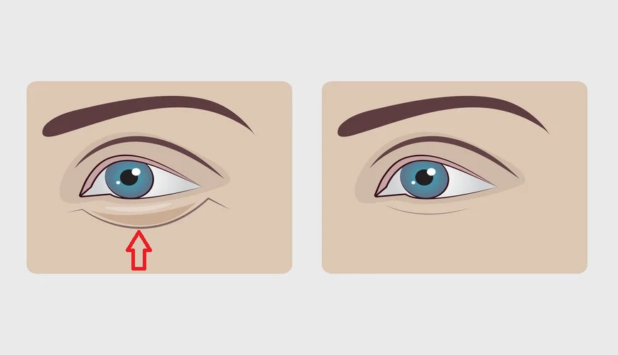 Bọng mắt lớn là đặc điểm người số giàu về sau